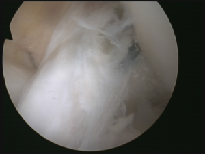 ACL Reconstruction