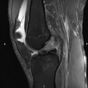 ACLD MRI 11