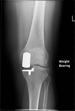 Unicondylar Knee Joint Replacement | Buckinghamshire Knee Surgery