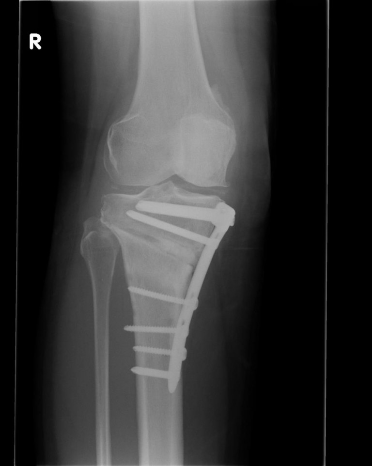 Osteotomy Buckinghamshire knee surgery