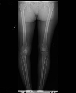 Osteotomy11-247x300